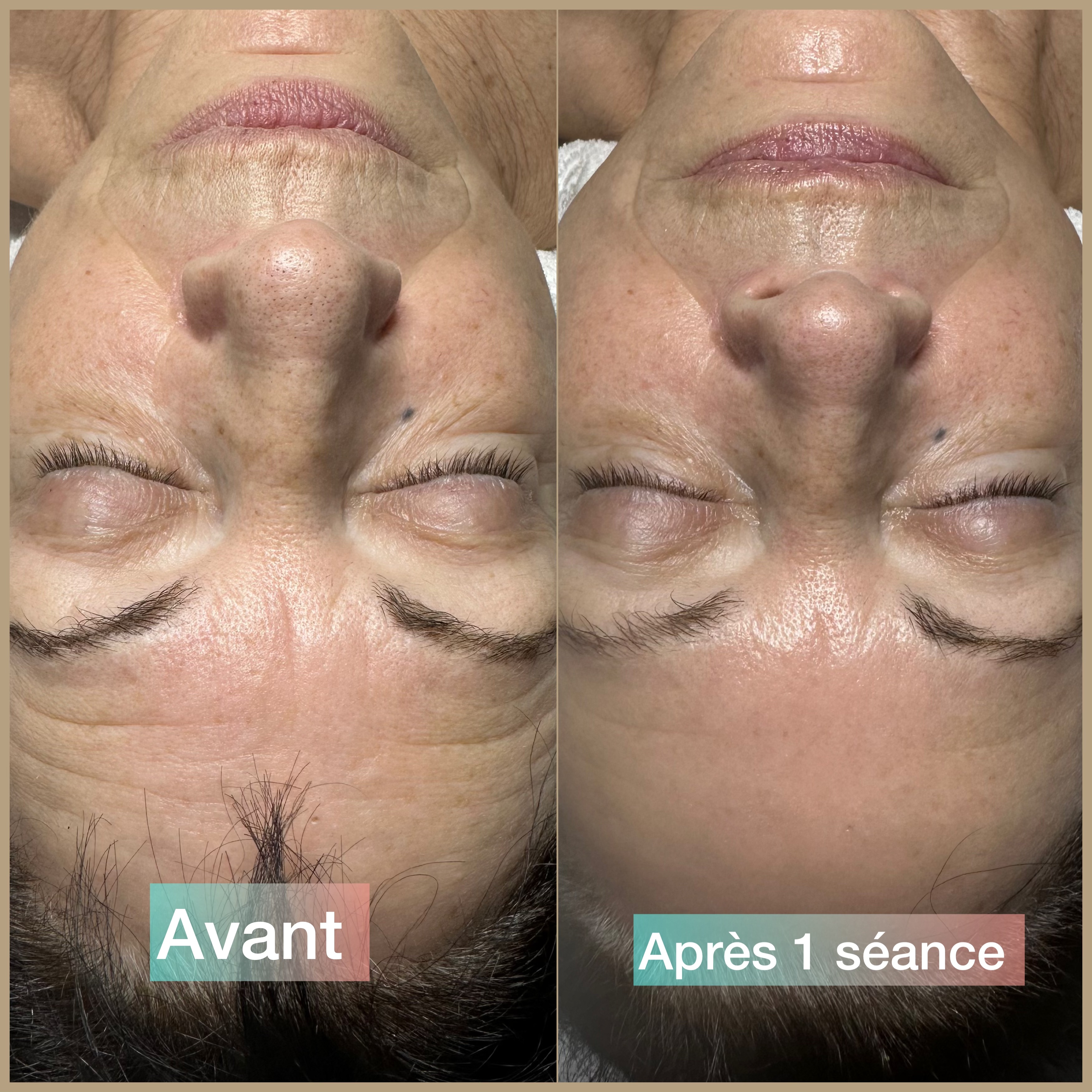 Avant/après 1 seule séance 